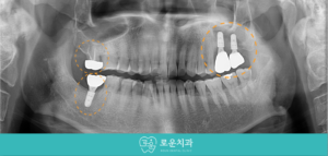 후