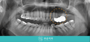 부산용호동임플란트