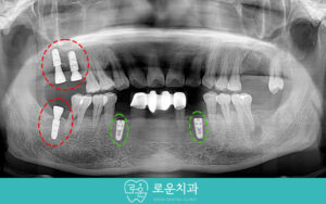 부산신경치료