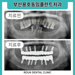부산용호동임플란트