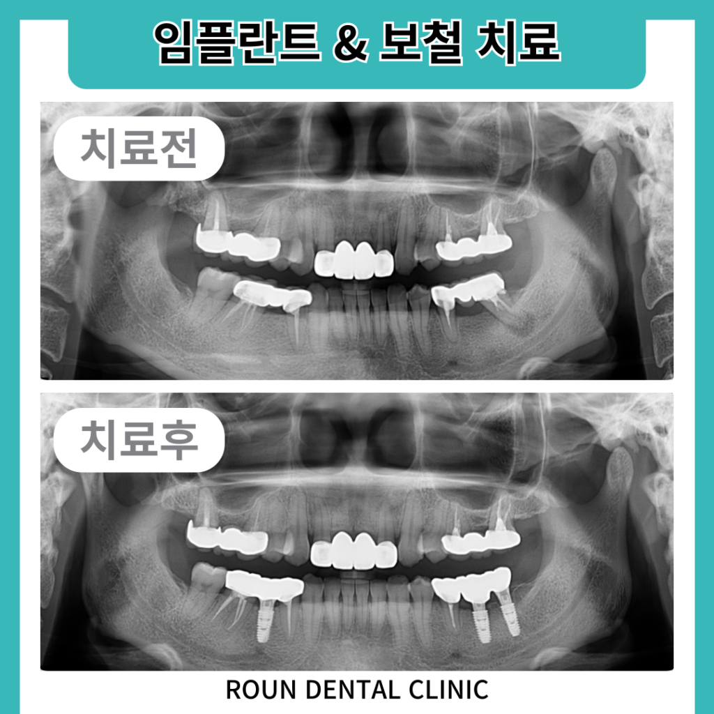 용호동임플란트